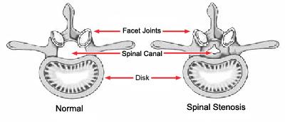 Illustrations of a healthy vertebra and a vertebra with stenosis