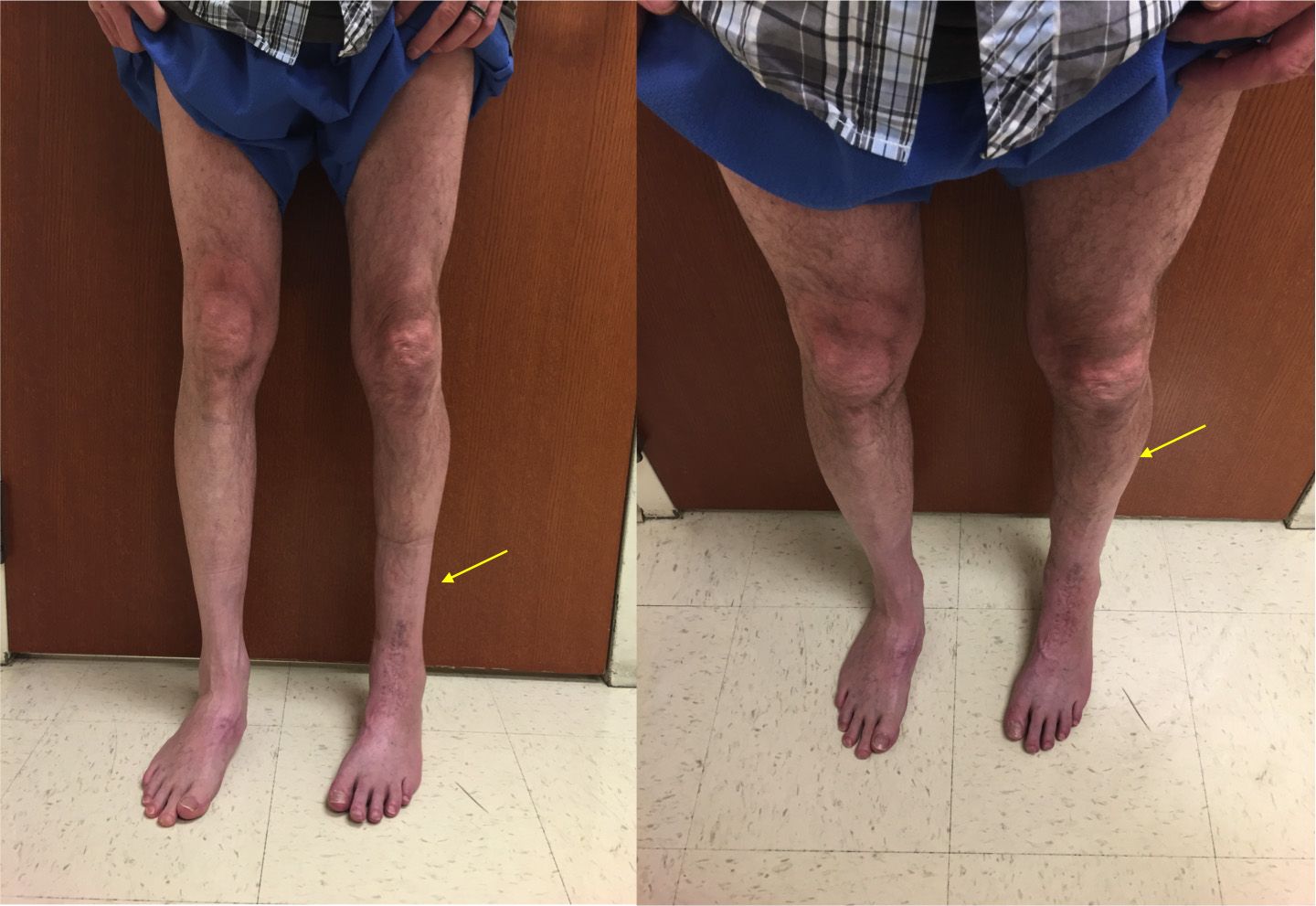 Lower Limb Length Discrepancy - OrthoInfo - AAOS