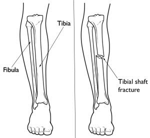 Illustrations of the lower leg and a tibial shaft fracture