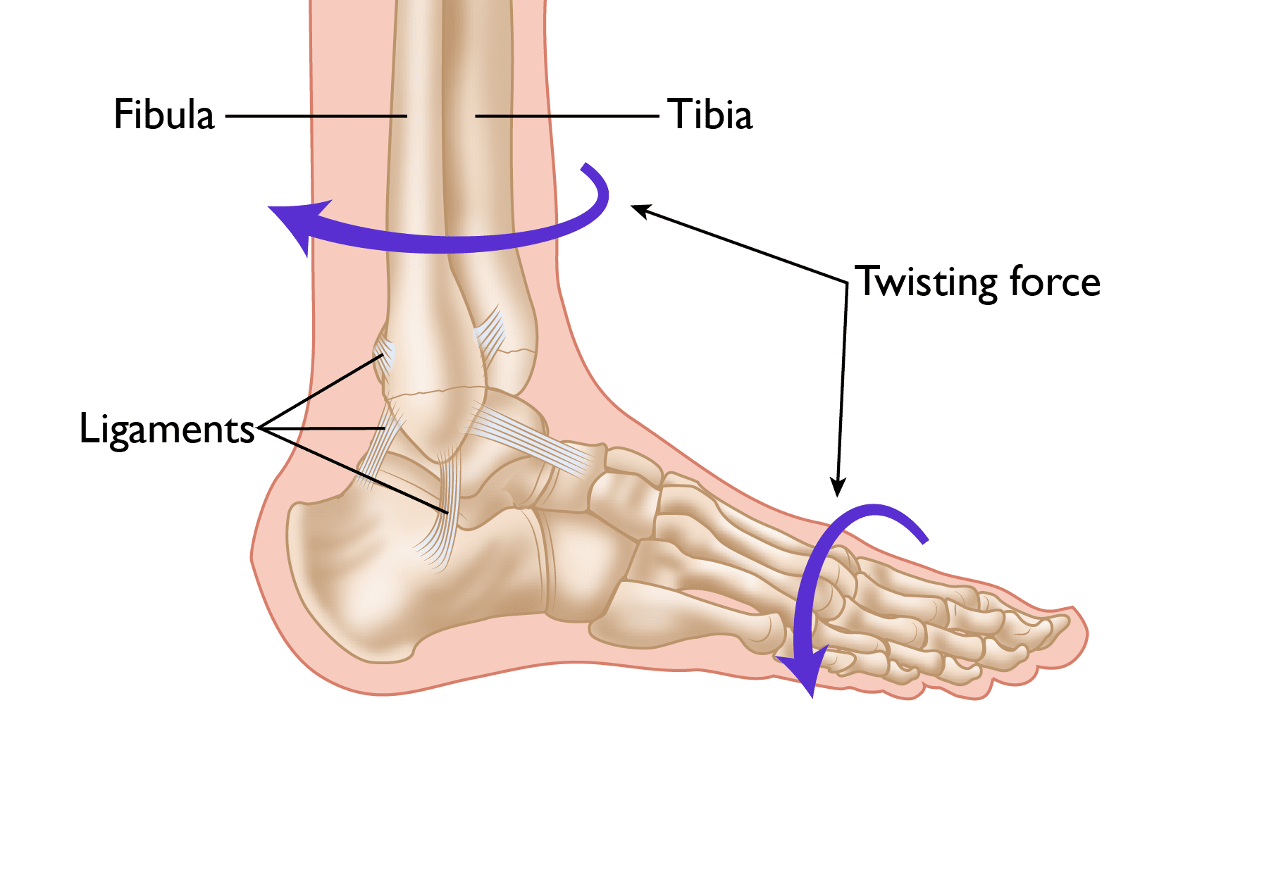 twisting force causing ankle sprain or fracture