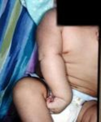 Infant with brachial plexus birth palsy