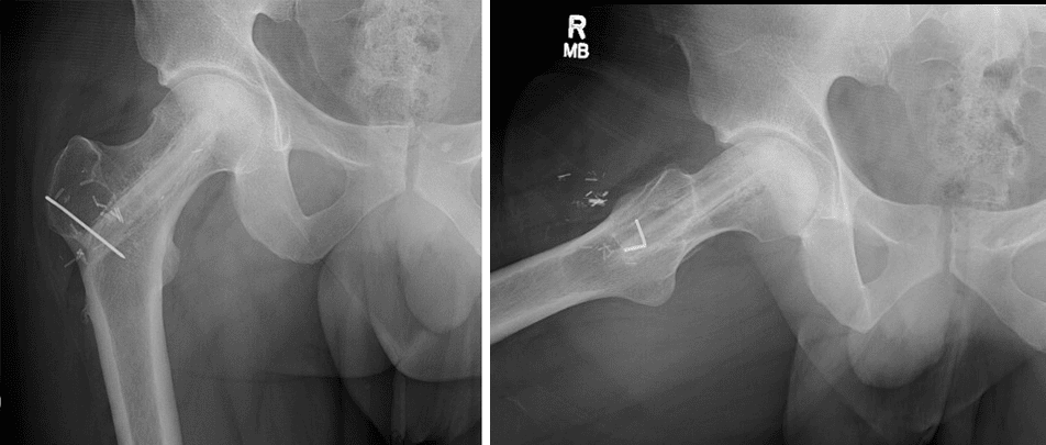 X-rays showing the hip after vascularized fibula grafting for osteonecrosis of the hip
