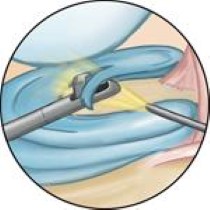 Desgarros de los meniscus (Meniscus Tears) - OrthoInfo - AAOS