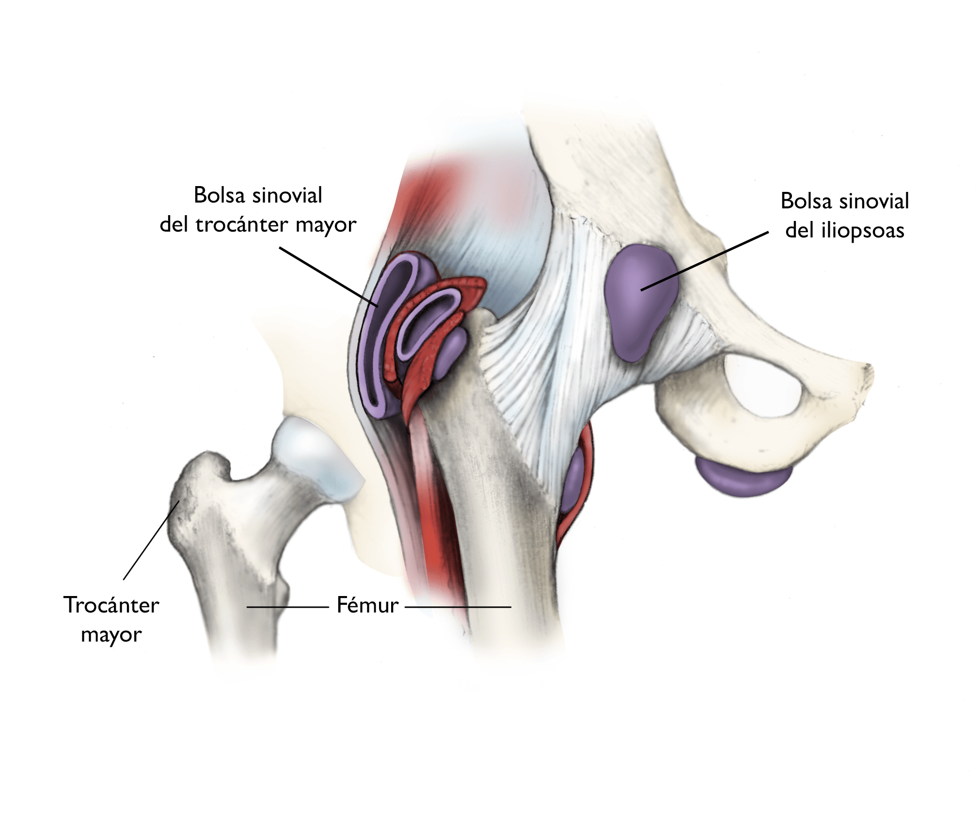 Lo más frecuente es que la bursitis de cadera involucre a la bolsa que cubre el trocánter mayor del fémur, aunque la bolsa del psoas-ilíaco también puede inflamarse. 