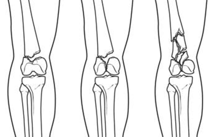 Different types of distal femur fractures