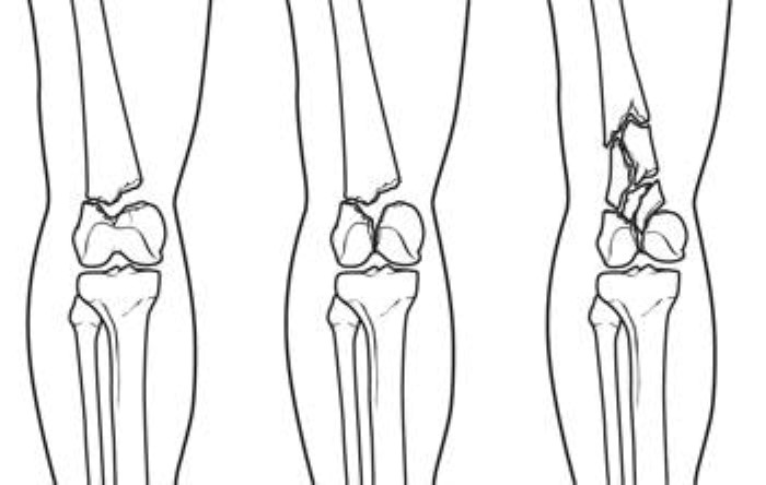 Distal Femur (Thighbone) Fractures of the Knee - OrthoInfo - AAOS