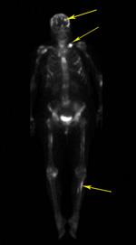 Metastatic Bone Disease Orthoinfo Aaos