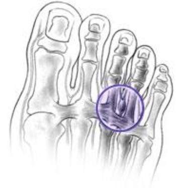 Morton's neuroma