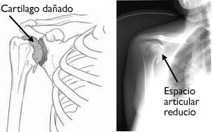 Arthritis of the Shoulder - OrthoInfo - AAOS