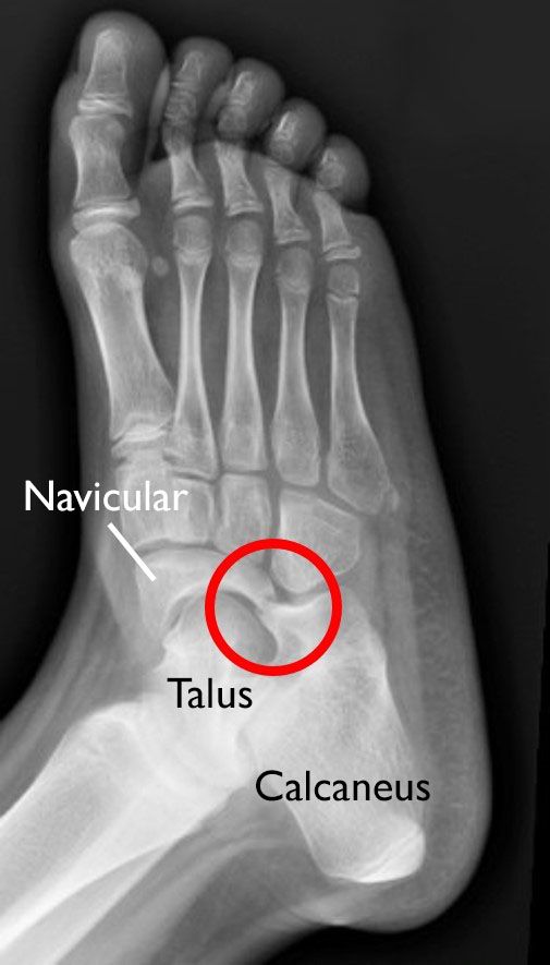 Talocalcaneal Coalition Mri