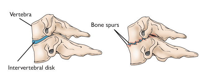 Illustrations of a healthy cervical vertebra and disk and a disk that has collapsed