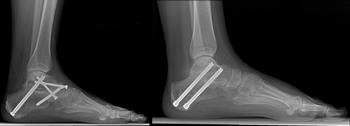 Ankle fusion