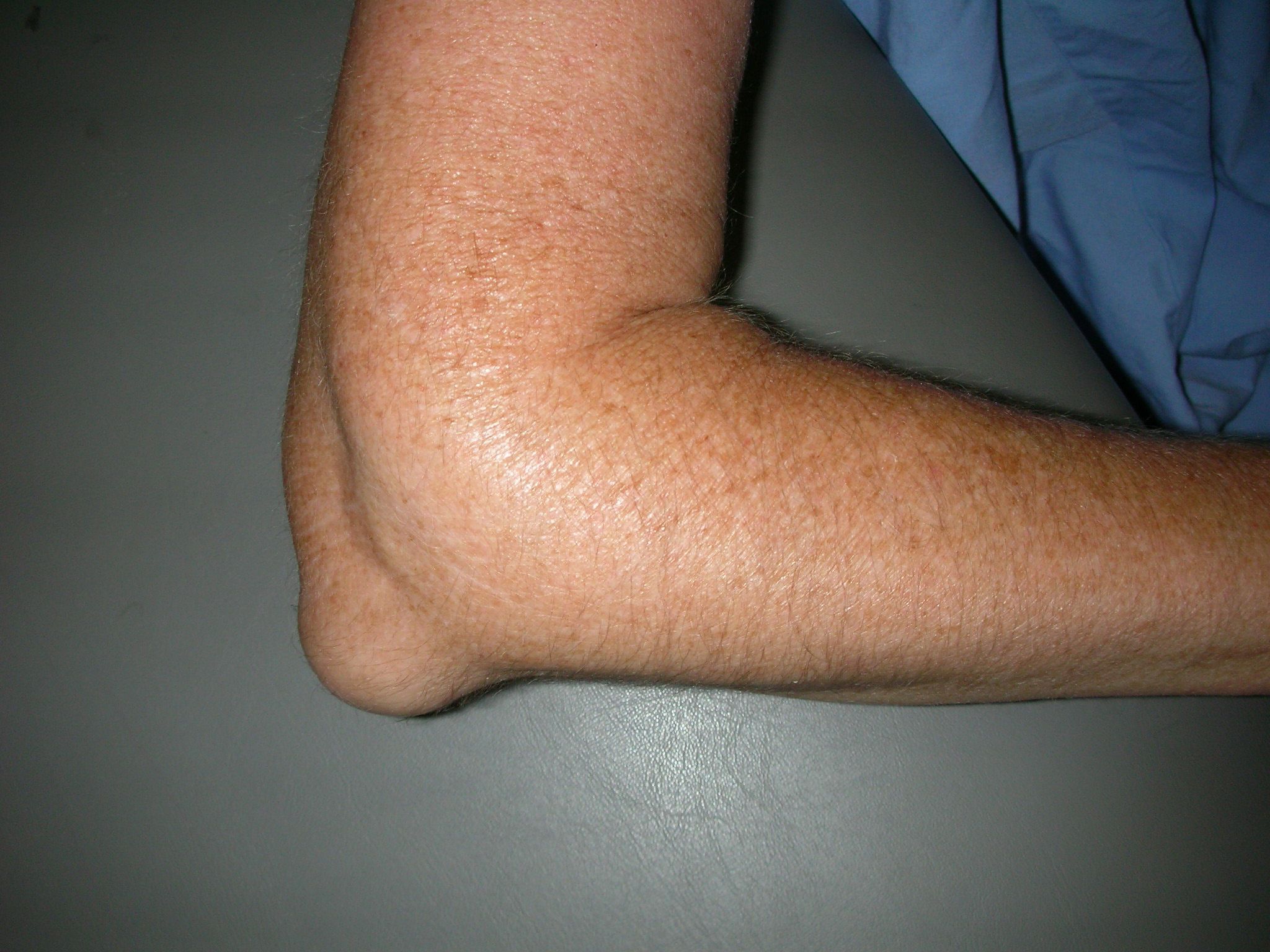 Elbow Olecranon Bursitis Orthoinfo Aaos 3287