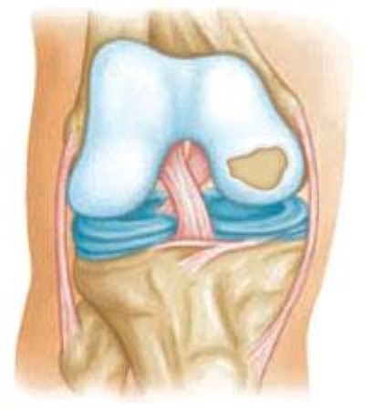 Exercises for Damaged Knee Cartilage