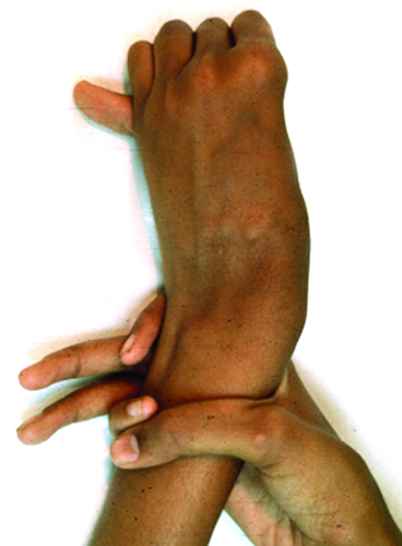 positive wrist sign for Marfan syndrome