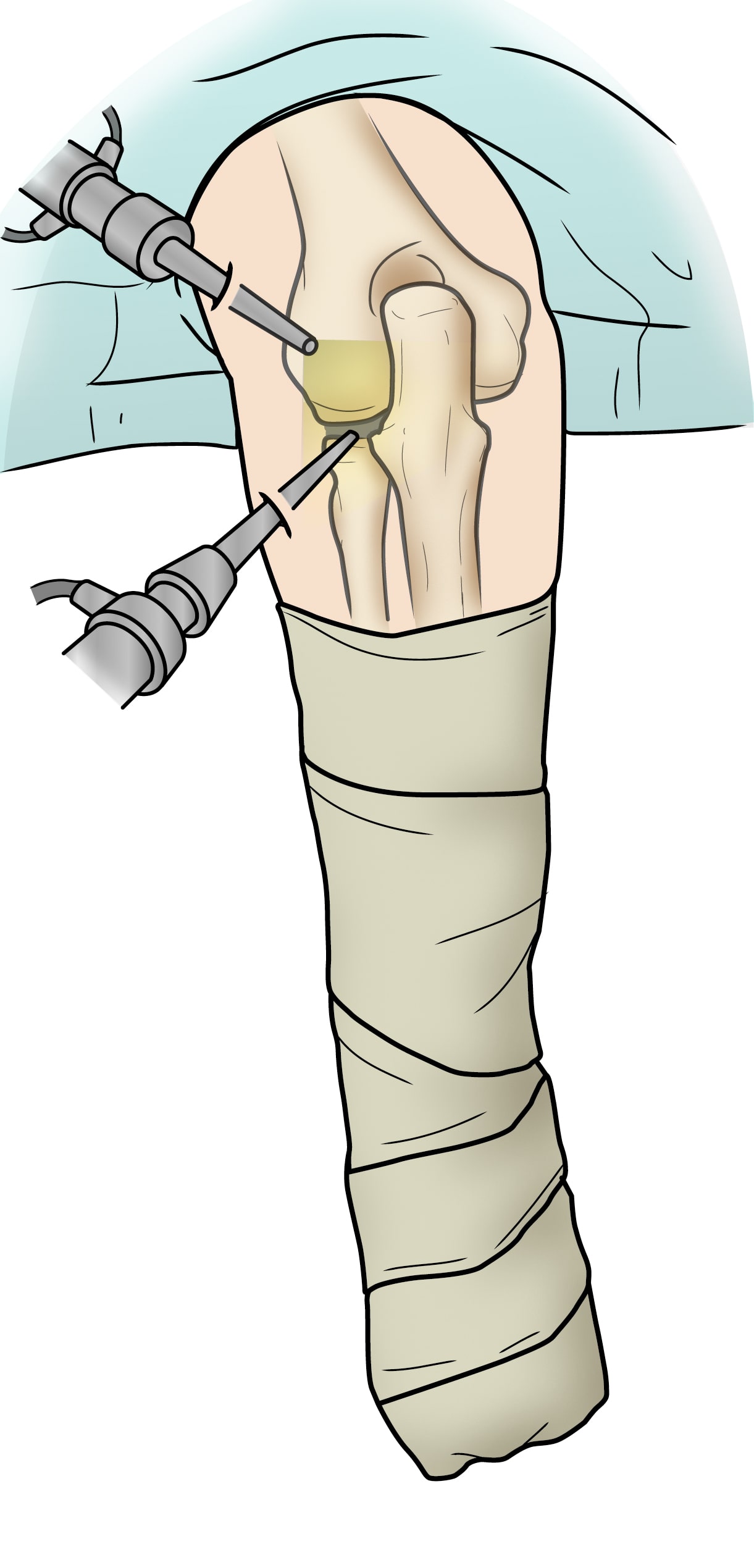 ilustración de artroscopia de codo