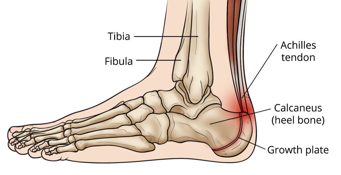 Sudden heel pain on clearance one foot