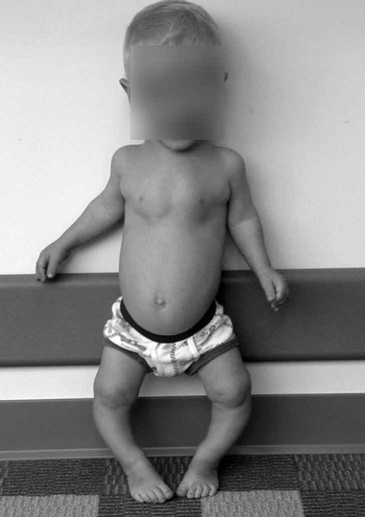 Young boy with achondroplasia