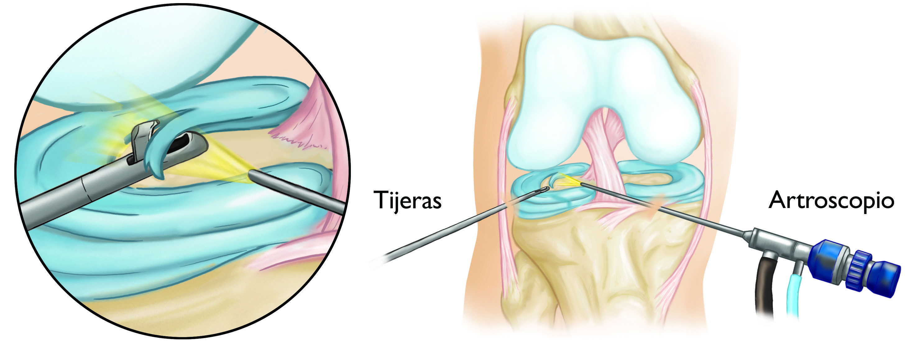 Tratamiento para distensión de la rodilla: MedlinePlus enciclopedia médica  illustración