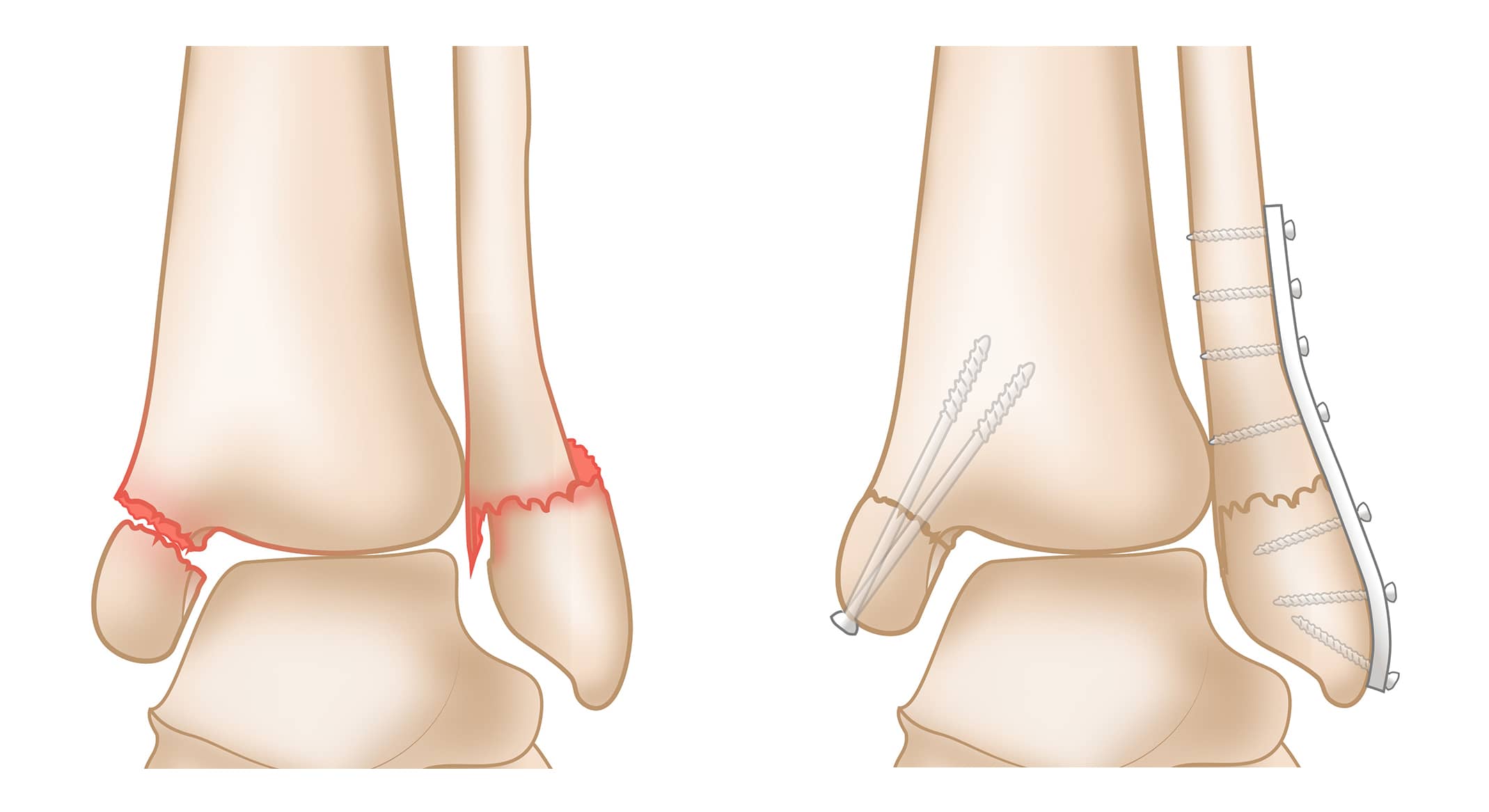 Bimalleolar Fracture and Repair