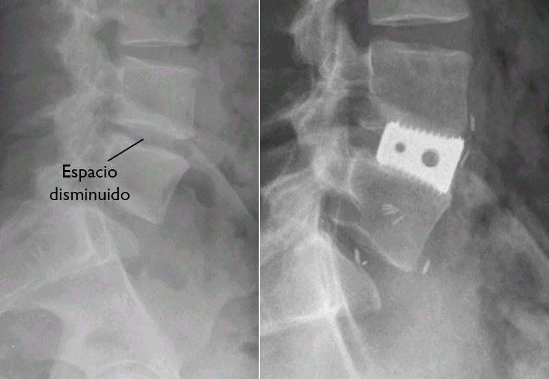 Fusi N Espinal Spinal Fusion Orthoinfo Aaos