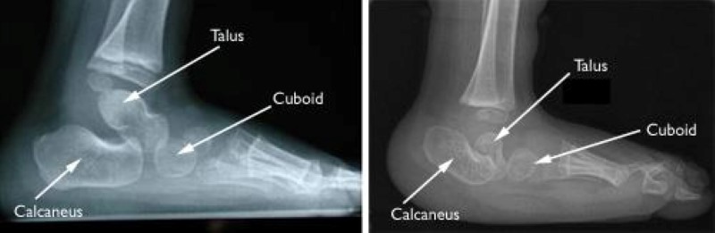 x-rays of normal foot and vertical talus