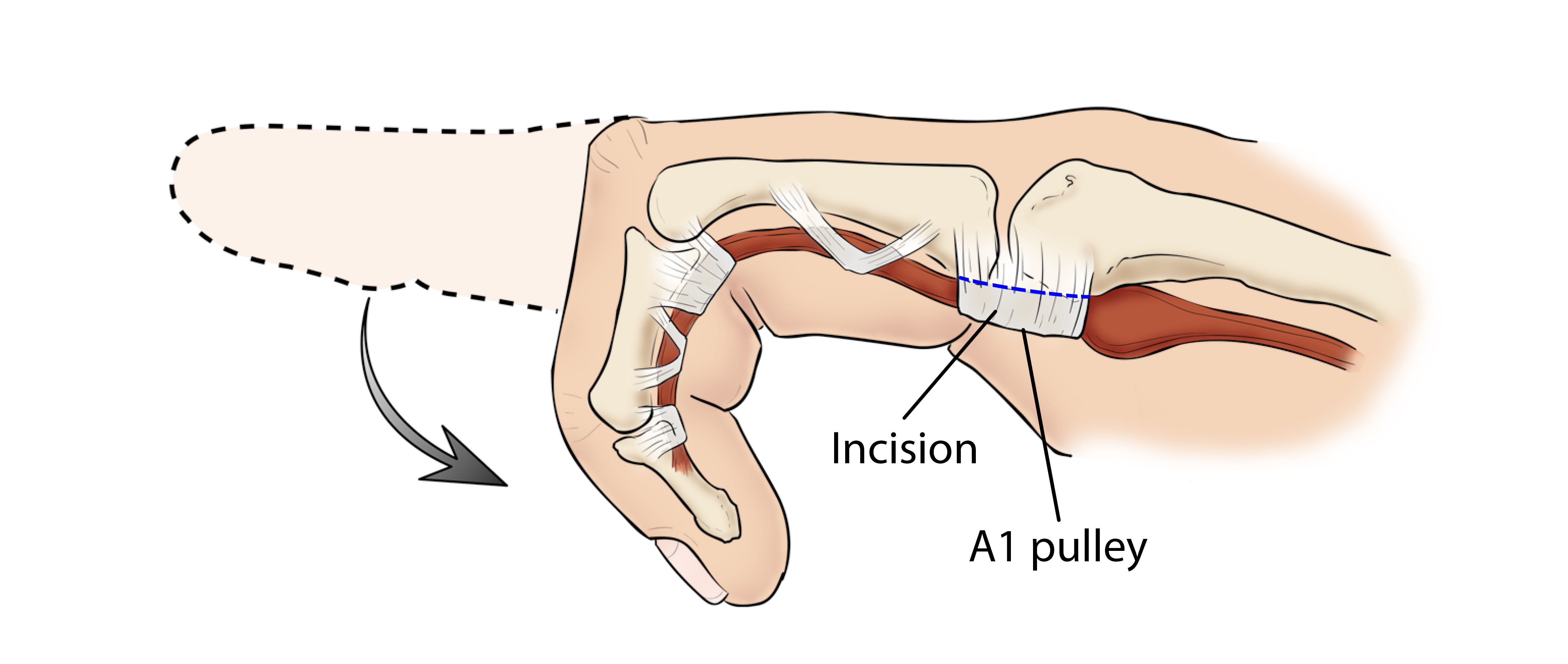 Trigger finger release surgery