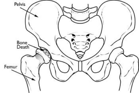 Osteonecrosis of the Hip - OrthoInfo - AAOS