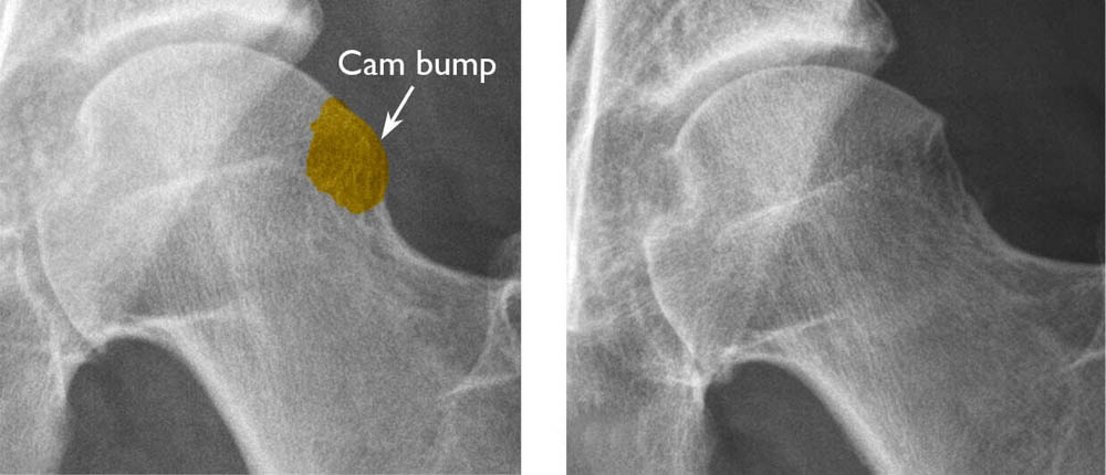 (Left) A cam bump on the femoral head. (Right) After the bump has been shaved down during surgery. 