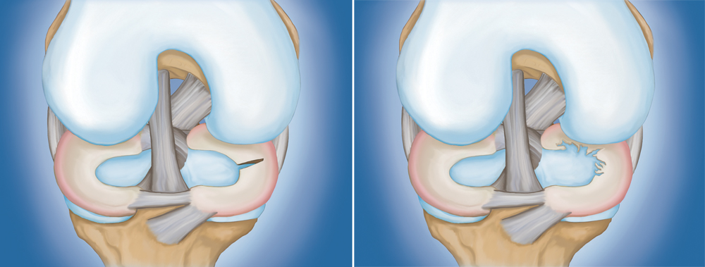 Common meniscus tears