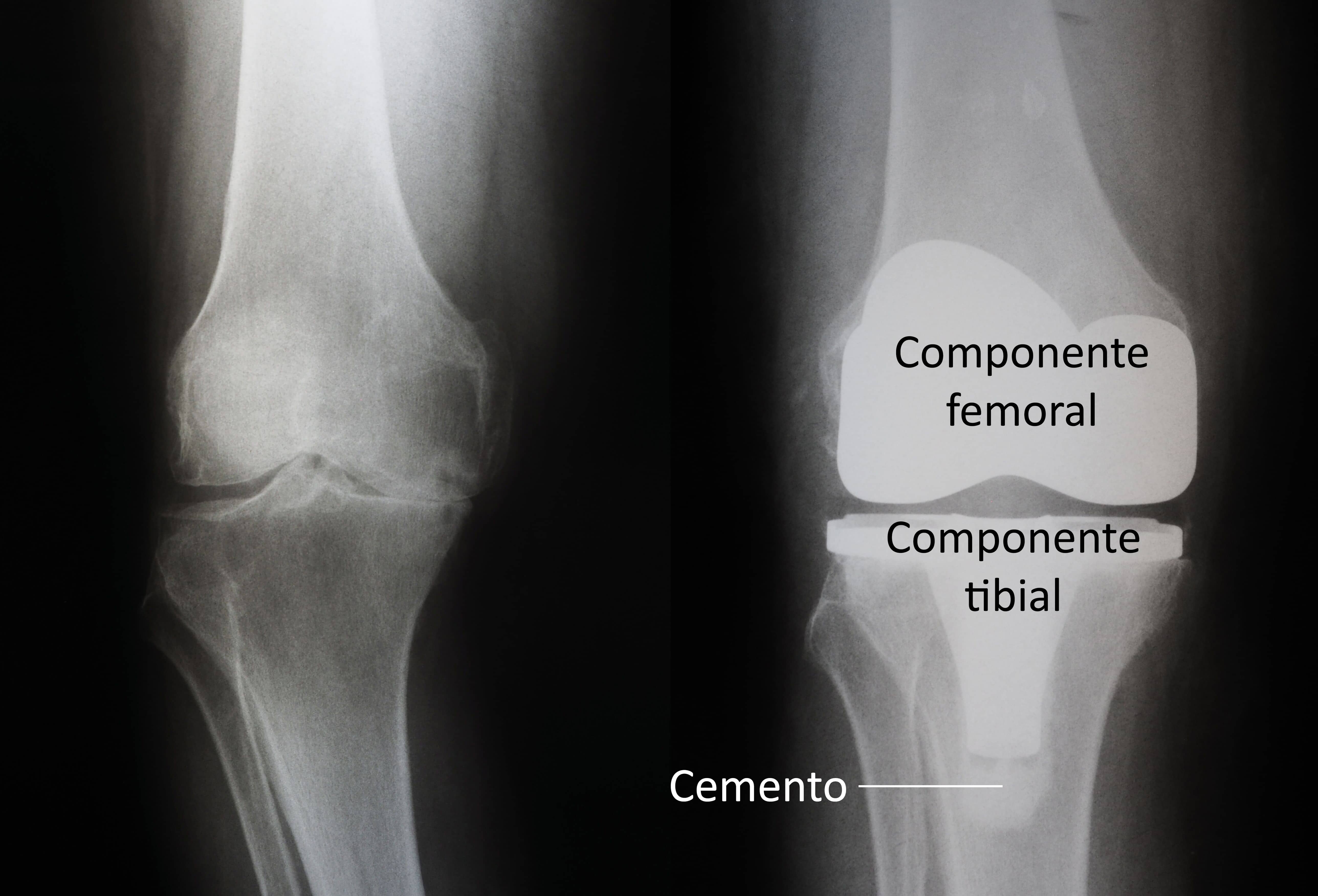 Artroscopia de rodilla - Serie—Anatomía normal: MedlinePlus