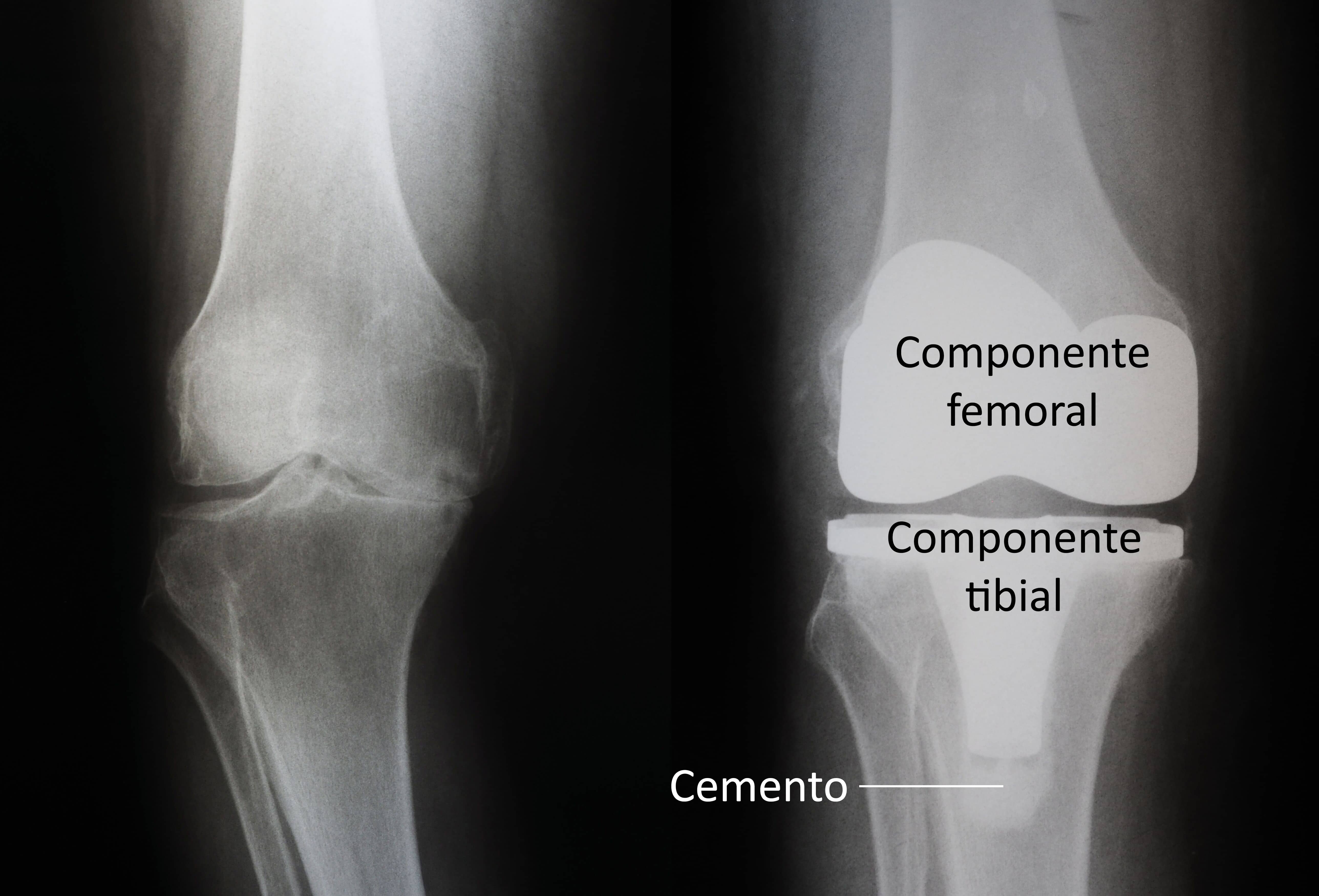 Artrosis de rodilla: ¿Cómo afecta y cuándo considerar la cirugía?