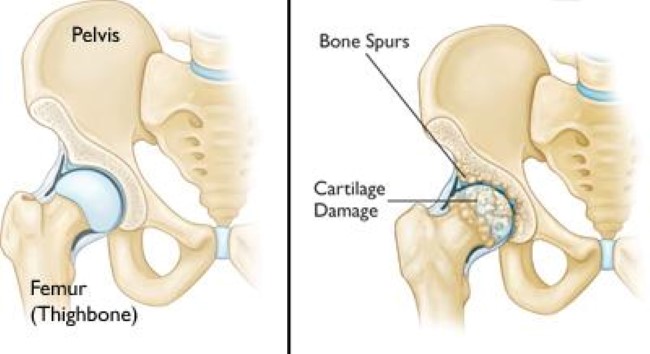 healthy hip anatomy and osteoarthritic hip