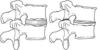 A normal spinal segment and a collapsed segment of spine