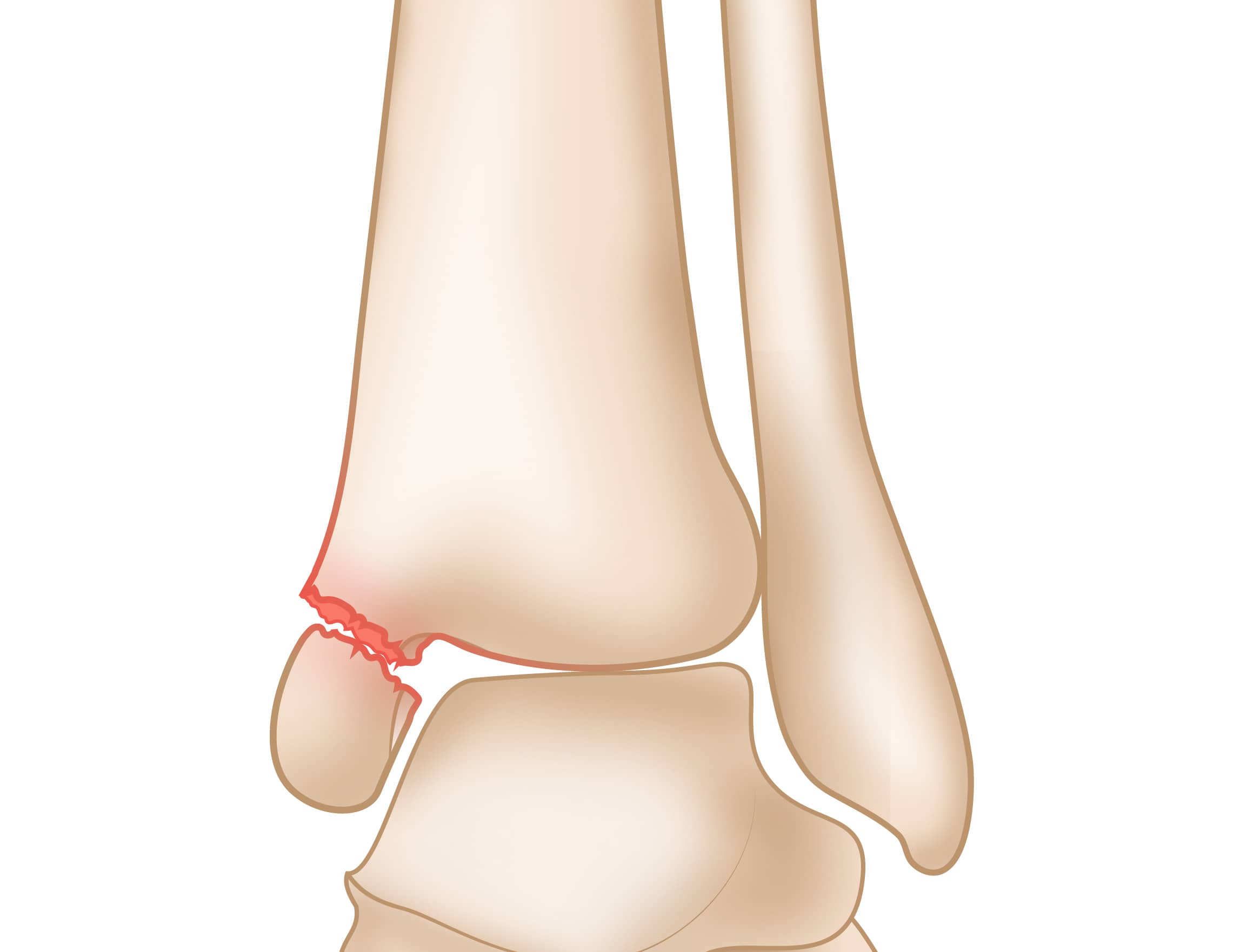 Example of the ankle cuff placement.