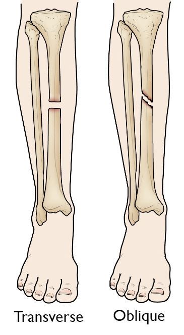 Tibia Shinbone Shaft Fractures OrthoInfo AAOS