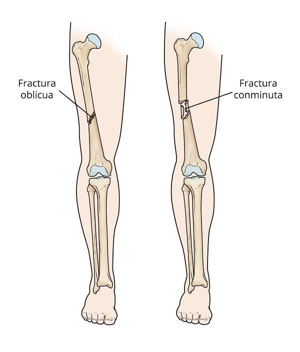 péndulo superávit inyectar Fracturas de la diáfisis femoral (ruptura del hueso del muslo) (Femur Shaft  Fractures (Broken Thighbone)) - OrthoInfo - AAOS