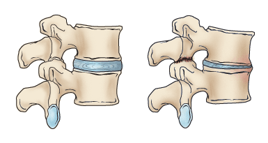 Spinal Stenosis - Ortho Illinois