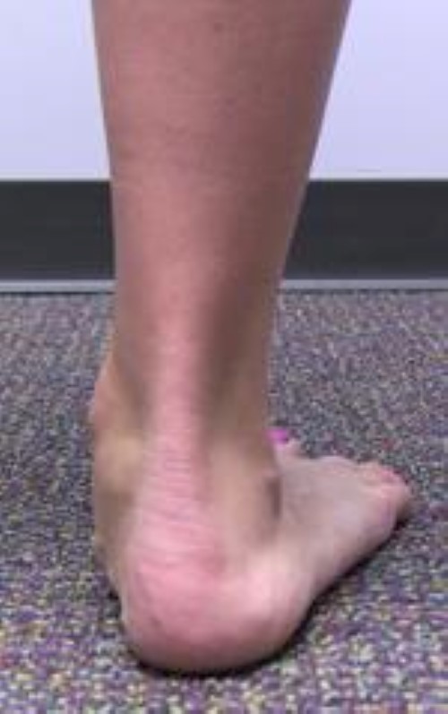 Effective Braces for Flat Feet