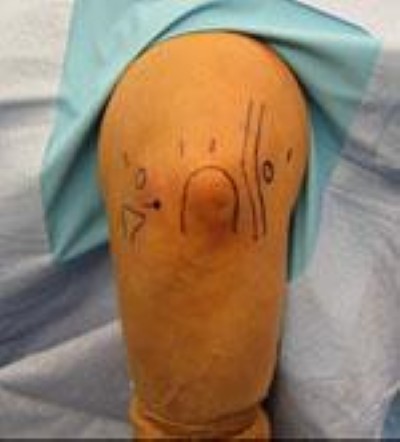 las líneas dibujadas en la piel durante la cirugía indican estructuras e incisiones