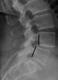 spondylolisthesis x ray