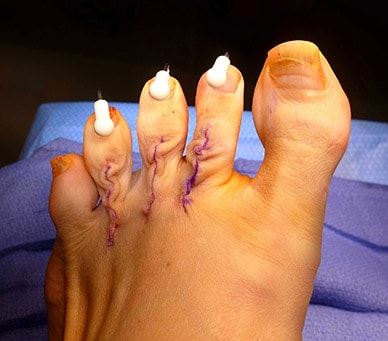 Hammer Toe Symptoms and Treatment Cincinnati and Dayton OH