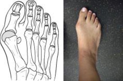 How Wide Feet Can Cause Pain