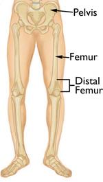 Distal Femur (Thighbone) Fractures of the Knee - OrthoInfo - AAOS