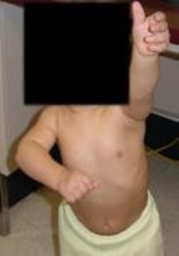 Toddler with brachial plexus birth palsy