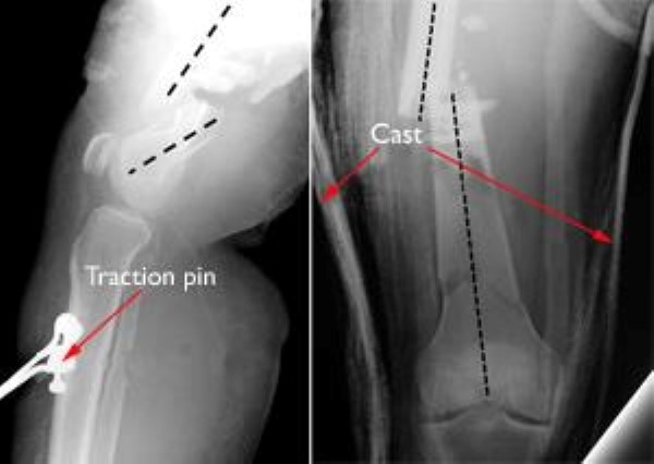 Distal femur fractures treated with traction and casting
