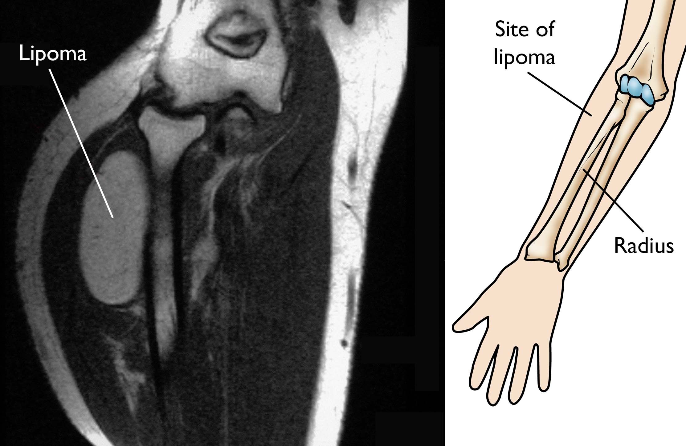 MRI of lipoma near elbow