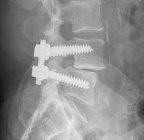 Fusión espinal Spinal Fusion OrthoInfo AAOS