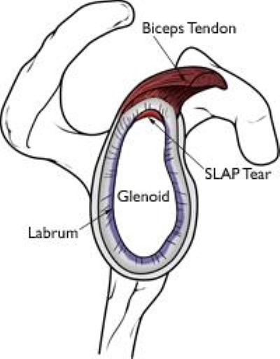 SLAP tear