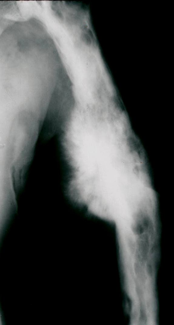 Paget Disease of the Bone